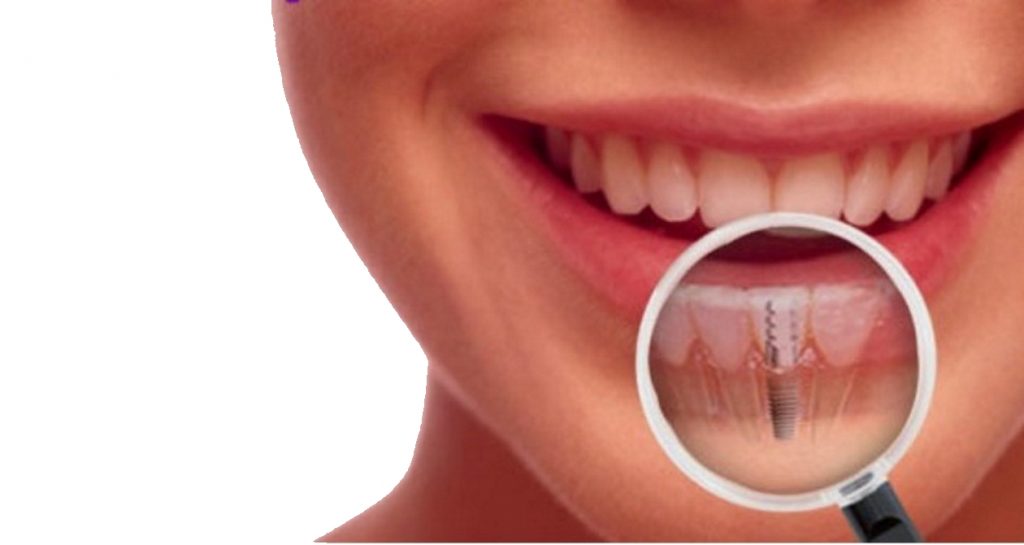 implantes dentales